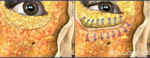 illustration of fat transfer (rest/contraction)