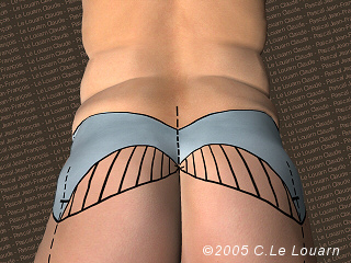 Plastie de fesses Docteur Claude Le Louarn