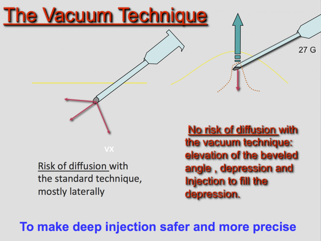 Docteur Le Louarn injections