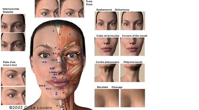 toxine botulique injection